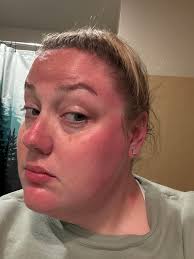 Don't worry about getting burned I got u with our after sun gel.