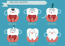 The number of roots a tooth has differs. How Long Does Root Canal Recovery Take