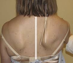 Image result for Winged Scapula