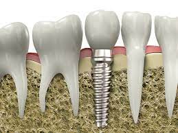 We did not find results for: Lost A Tooth Replace It With A Dental Implant Smiles 4 Grant Park Abbey Lee Dmd