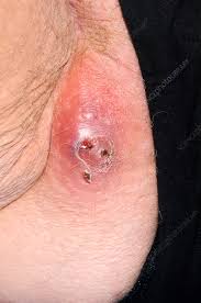 Image result for Perirectal Abscess