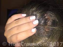 Find out why this is and how you can maintain great hair color without damaging your hair and scalp with head & shoulders. Scabs All Over Scalp After Bleaching Help Forums Haircrazy Com