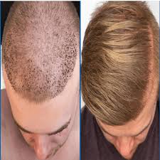 With the fall of an old hair, the growth of a new one comes in and the process starts over again. How To Increase Hair Growth Rate After A Hair Transplant