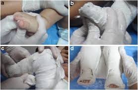Ponseti method also known as stretching and casting, is a manipulative technique that corrects congenital clubfoot (congenital talipes equinovarus) without invasive surgery 1). Clinical Outcomes Of Iatrogenic Complex Clubfoot Treated With Modified Ponseti Method Springerlink
