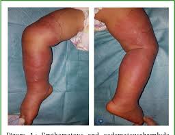 Image result for erysipel photos)