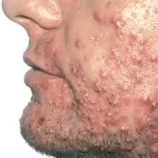 L'acné : cause, symptôme et traitement - DCP Derm