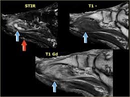 Mri is the modality of choice in differentiating palpable masses around the foot from anatomical variants like accessory muscles. The Radiology Assistant Mri Examination