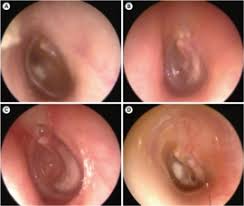 Image result for Myringosclerosis