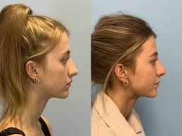 Nose Surgery Gallery