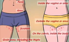 Hpv Human Papilloma Virus Aras Asociatia Romana Anti Sida