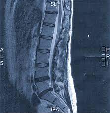 Bandscheibenvorfall Symptome Therapie Operation