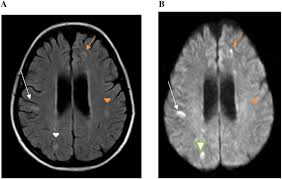 Moreover, gbs is also associated with any vaccination. Concurrent Guillain Barre Syndrome Transverse Myelitis And Encephalitis Post Zika A Case Report And Review Of The Pathogenic Role Of Multiple Arboviral Immunity Journal Of The Neurological Sciences
