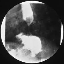 Symptoms can be vague, which can make early diagnosis difficult. Krankheiten Von Osophagus Magen Und Duodenum Springerlink