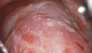 Oral herpes can be spread through intimate contact with someone who is infected. Herpes Simplex Virus 1 2 Clinical Advisor
