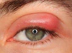 Arpacik Tedavisi Evde Eyestyeremedies Saglik Evde Hazirlabilen Ilaclar Rozasea