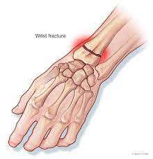 Maybe you would like to learn more about one of these? Hand Wrist Fractures Mayo Clinic Orthopedics Sports Medicine
