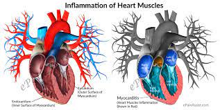The heart muscle may be damaged even more if your body's immune system sends antibodies to try to fight whatever started the inflammation. Myocarditis Or Inflammation Of Heart Muscles Causes Symptoms Treatment Experiences