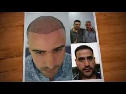 Diğer ekim yöntemleriyle karşılaştırdığımızda, long hair fue yönteminde, operasyon süresi ve saç ekimi süreci değişmiyor. Turkiyenin En Iyi Sac Ekim Merkezi 2018 Sac Ekimi Youtube