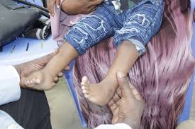 Überprüfen sie die übersetzungen von 'clubfooted' ins deutsch. Somali Ponseti Clubfoot Care Organization Sopcco Twitter