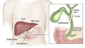 Bile Duct Cancer Homeopathy Treatment Lucknow Mumbai Delhi India Expert Cancer Homoeo Clinic