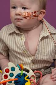 First pediatric partial heart transplant performed at Dell Children's