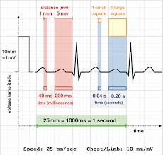 Ecg Rate Interpretation Litfl Medical Blog Ecg Library Basics