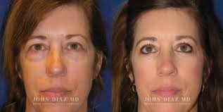 Beverly Hills Plastic Surgeon