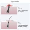 Cyst Ingrown Hair