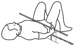 Sagittal Abdominal Diameter Wikipedia