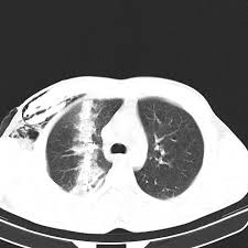 Viewing Playlist April Pin Radiopaedia Org Radiologia