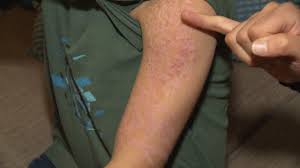 They noticed that there was a severe rash on. Boy Left With Burn Like Scars From Henna Tattoo In Mexico Ctv News
