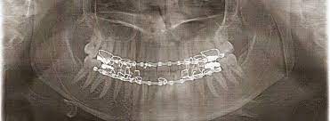 Tips On Having Your Mouth Wired Shut Liquid Diet Recipes Jaw Surgery Jaw Surgery Double Jaw Surgery