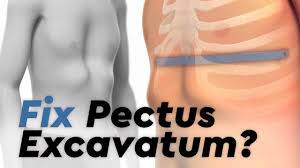 Image result for Pectus Excavatum