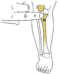 Image result for Intraosseous Access