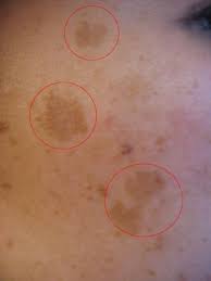 Maybe you would like to learn more about one of these? How To Remove Dark Patches And Spots From Your Face Bellatory
