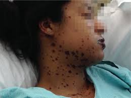 Stevens-Johnson Syndrome After Armodafinil Use