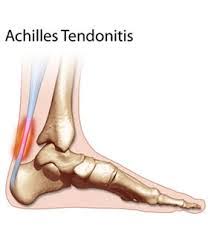 A well get plenty of rest: How To Avoid Achilles Tendonitis Active Physio Health