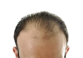 Haarwuchsmittel Auf Dem Prufstand Super Million Hair