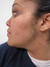 Polycystic Ovarian Syndrome Stein Leventhal Syndrome Polycystic Ovarian Disease Functional Ovarian Hyperandrogenism Ovarian Hyperthecosis Sclerocystic Ovary Syndrome Dermatology Advisor
