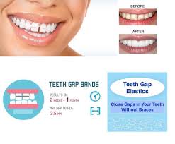 It can make your gums tender and sore and even lead to gum disease. Wish And Box Orthodontic Elastic Gap Teeth Bands Floss Size 1 8 3 16 1 4 5 16 3 8 Medium 500 Bands Amazon In Health Personal Care