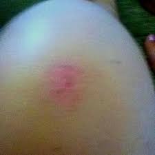 Look At My Rug Burn Look At Me Burns