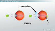 Concave Lens | Definition, Uses & Examples - Lesson | Study.com