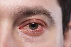 Image result for Allergic Conjunctivitis