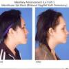 The habsburg jaw actually is caused by a medical condition doctors refer to as mandibular references is the habsburg jaw related to inbreeding? 1
