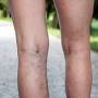 treatment for spider veins from www.aad.org