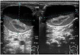 Diagnostico Prenatal De 10 Quistes De Ovario Fetal Manejo Posnatal