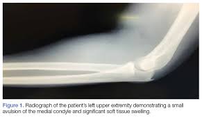 Image result for Fall on Outstretched Hand