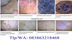 Pin Di Obat Kutil Kelamin