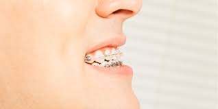 If you or someone in your family is living with a crossbite, the best course of action is to schedule a visit with your dentist for a full examination. How To Correct Your Crossbite In South Pasadena Ca