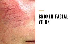 When small, fragile blood vessels break below the tissue covering the white of the eye (conjunctiva), resulting eye redness might indicate that you have a. How To Get Rid Of Broken Blood Vessels On Face Vein Solutions